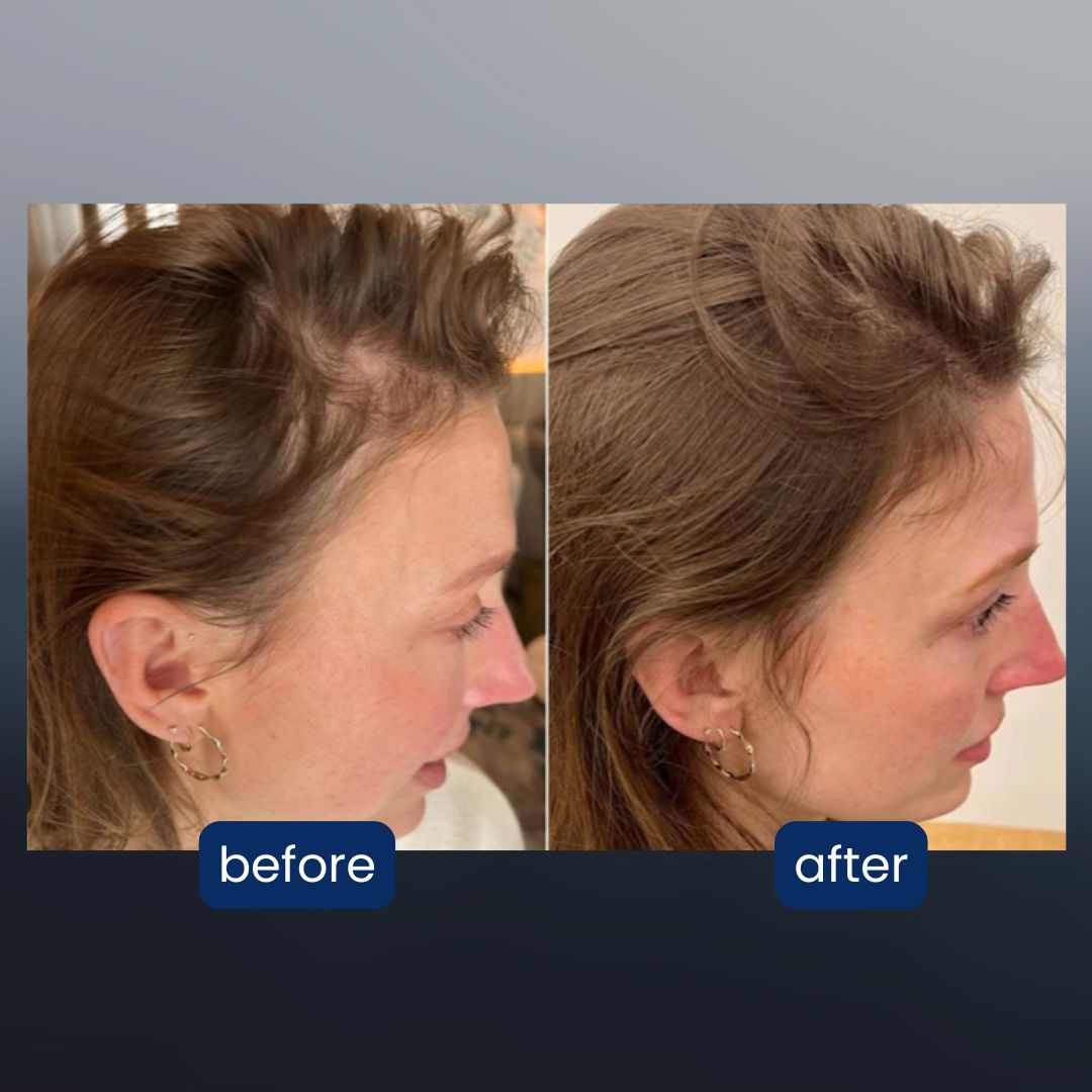 revive - 3-in-1 scalp massager for thinning hair