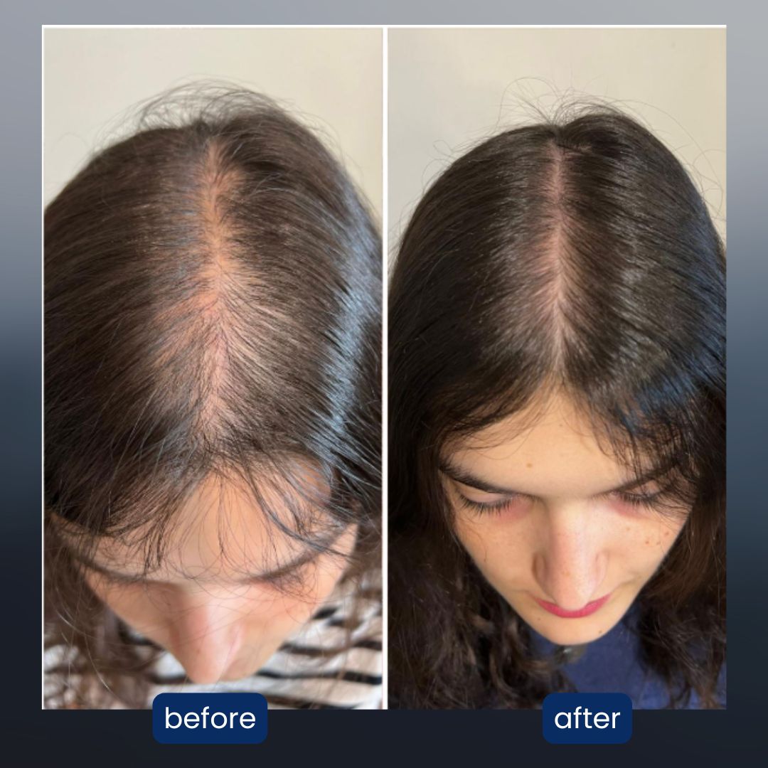 revive - 3-in-1 scalp massager for thinning hair